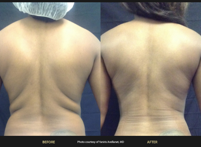 Womans back flanks before and after BeautiFill liposuction.