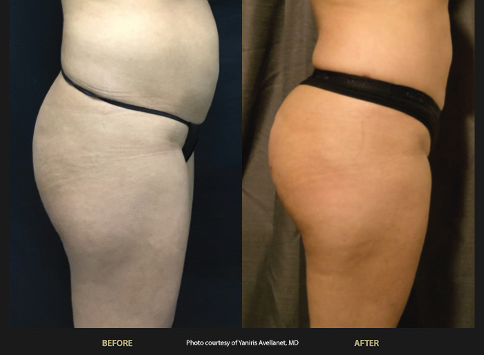 Womans buttocks before and after BeautiFill Laser Liposuction and fat transfer.