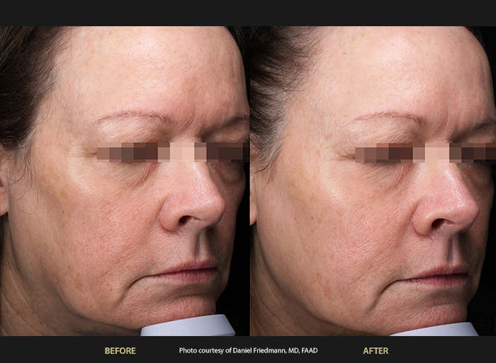 Womans face before and after BeautiFill Laser Lipo in Sandy Springs.
