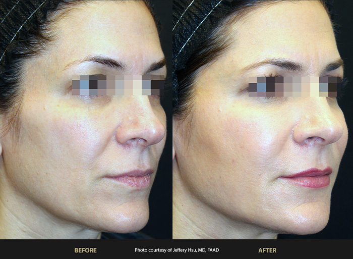 Womans face before and after BeautiFill Laser Lipo.