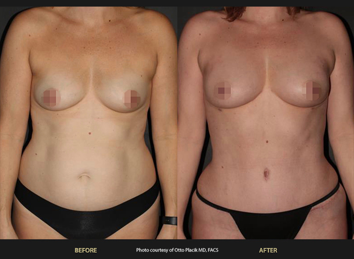 Womans abdomen before and after BeautiFill Laser Lipo.