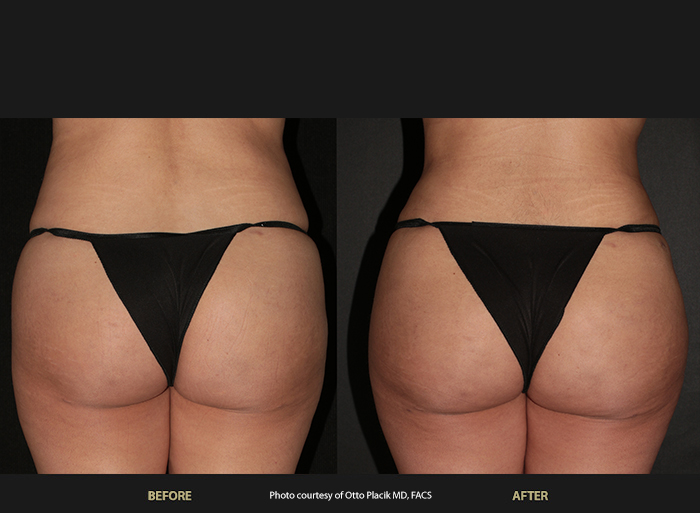 Womans before and after BeautiFill Laser Lipo and fat transfer by the experts at WEllife