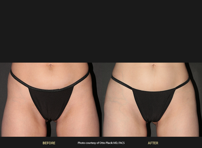 Womans before and after of hips with BeautiFill Laser Lipo and fat transfer in Sandy Springs, GA.