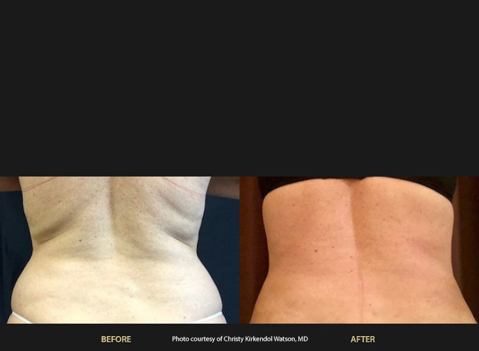 Womans back blanks before and after BeautiFill Laser Lipo treatment at Wellife.