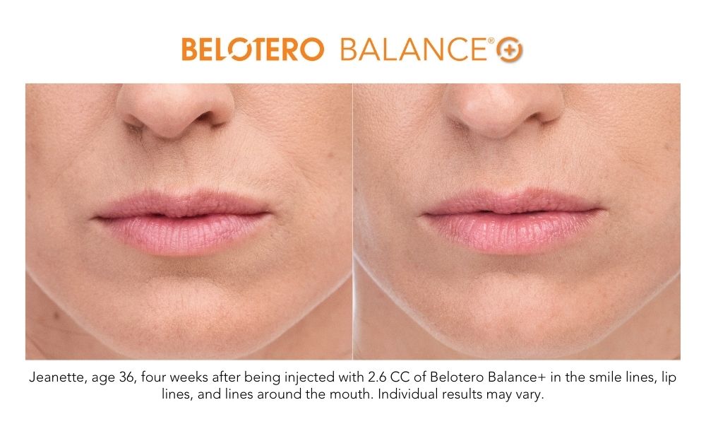 Woman's lips before and after Belotero results.