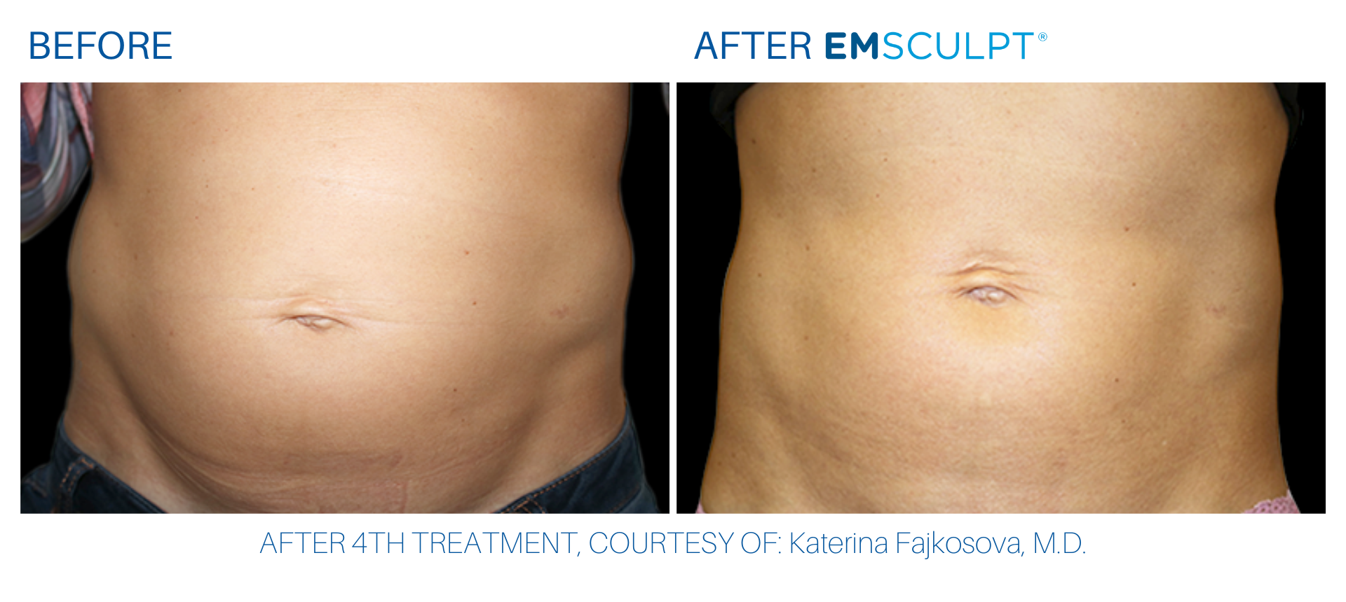 Abdomen before and after Emsculpt treatment in Sandy Springs, GA at Wellife Ageless Center.