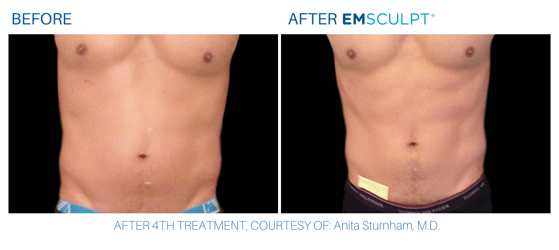 Abdomen before and after Emsculpt at Wellife.