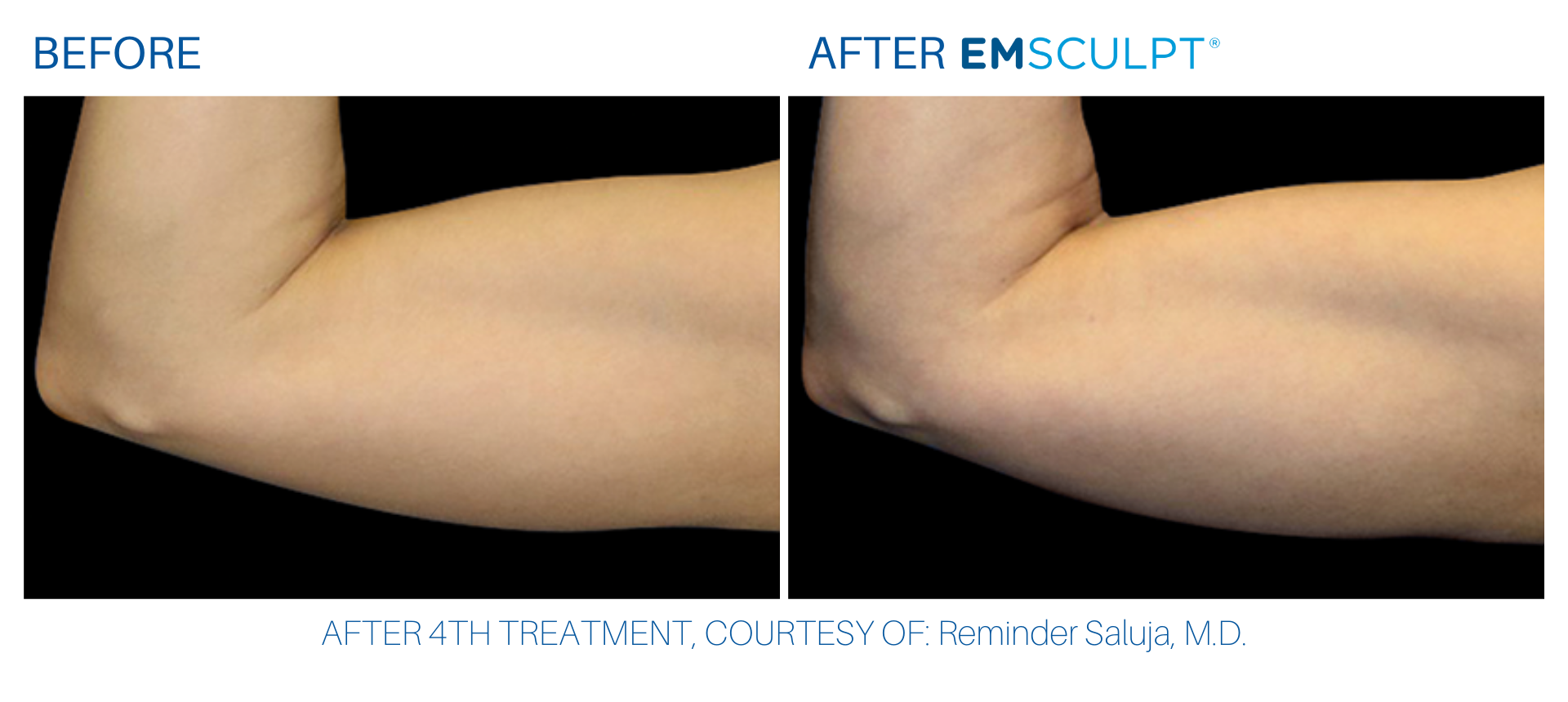 Bicep before and after Emsculpt treatment at Wellife Center.