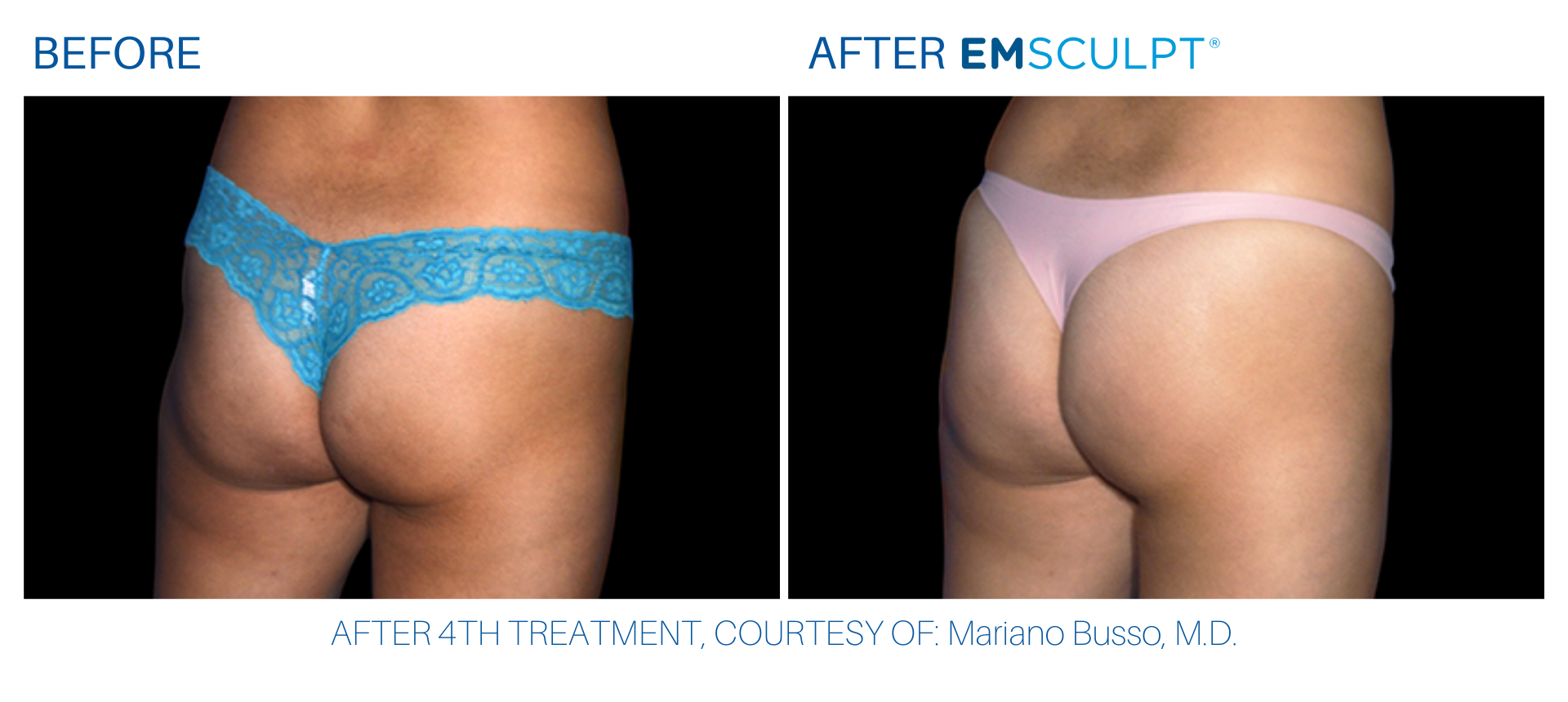 Buttocks before and after Emsculpt treatment at Wellife Ageless Center.