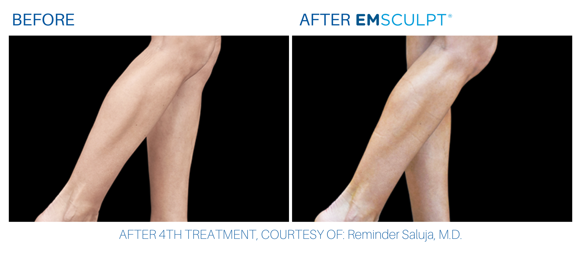 Calf muscles before and after Emsculpt done at Wellife Center in Sandy Springs, GA.