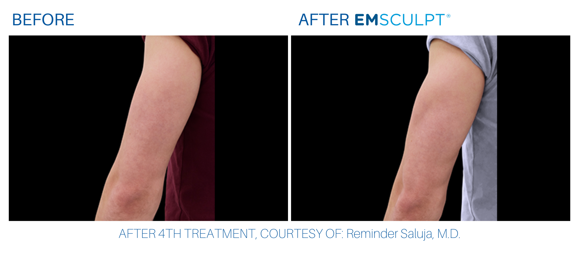 Triceps before and after Emsculpt at Wellife in Sandy Springs, GA.