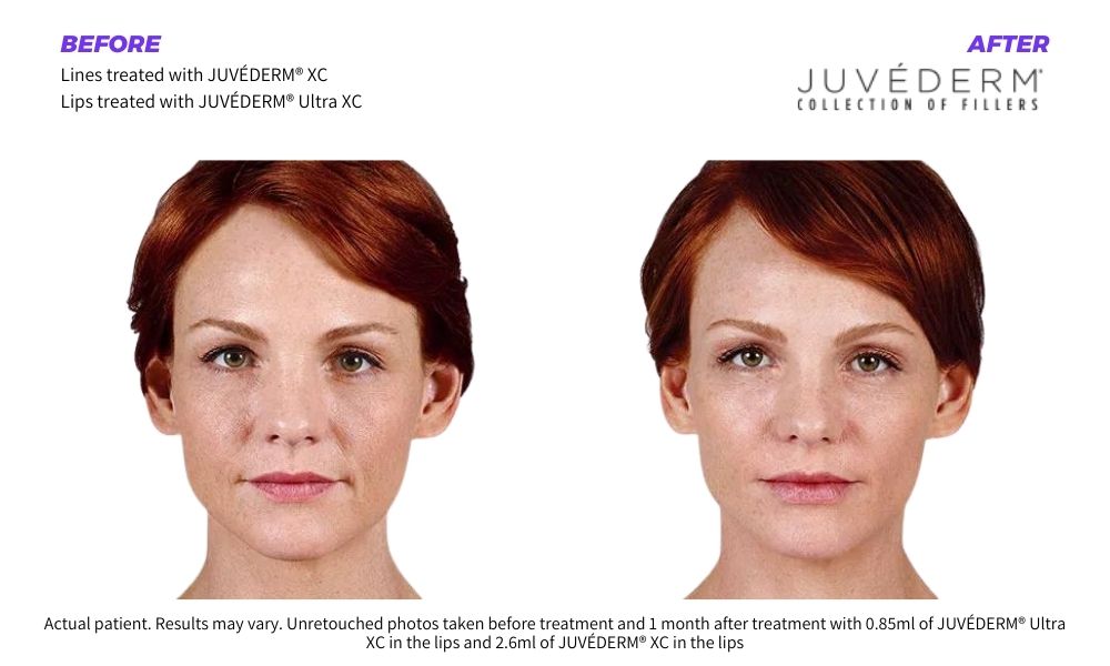 Woman's before and after juvederm dermal fillers.