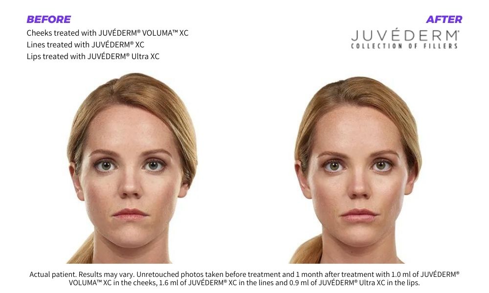 Woman's before and after juvederm dermal fillers results.