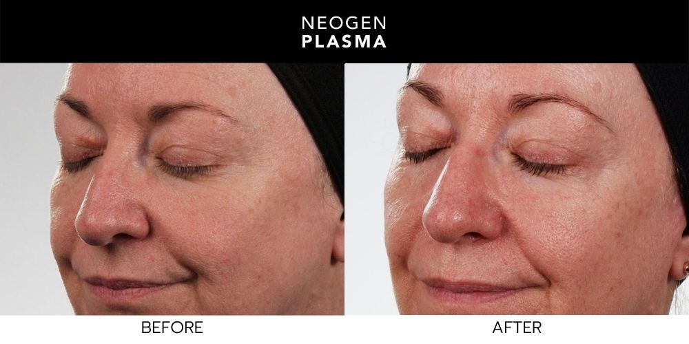 Woman in 50s with looking beautiful with non surgical face lift before and after Neogen Plasma treatment at Wellife Ageless Center in Sandy Springs, GA.