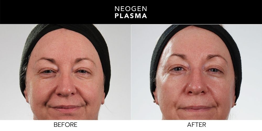 Woman in 50s with looking beautiful with non surgical face lift before and after Neogen Plasma treatment at Wellife Ageless Center in Sandy Springs, GA.