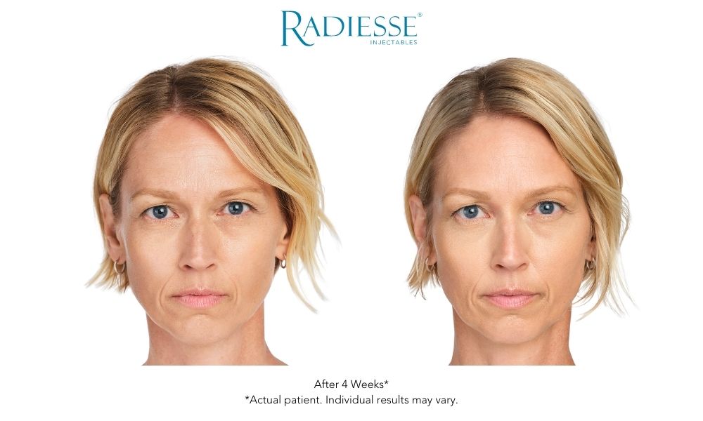 Woman's face Radisse dermal fillers before and after results.