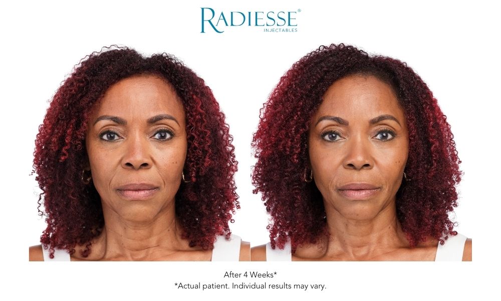 Woman's face Radisse dermal fillers before and after results.