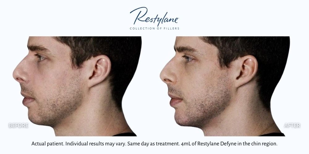 Man's Restylane dermal fillers before and after results.