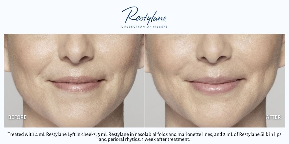 Woman's Restylane dermal fillers before and after results.