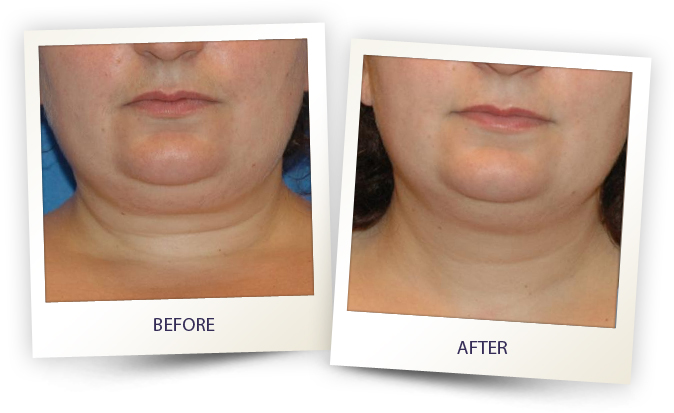 Alma laser before and after treating the chin area for facial contouring in Sandy Springs.