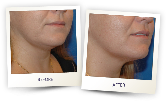 Womans chin showing before and after results of face contouring with Alma laser accent prime treatment.