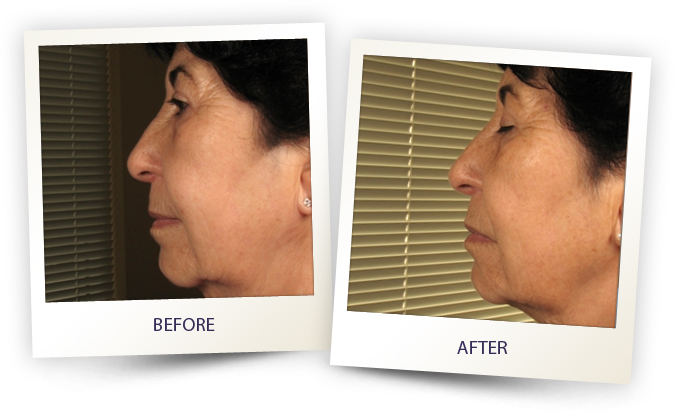 Middle aged woman showing before and after facial contouring results from alma laser treatment at Wellife Ageless Center.
