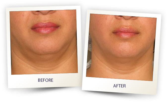 Chin area before and after alma laser face contouring treatment in Sandy Springs.