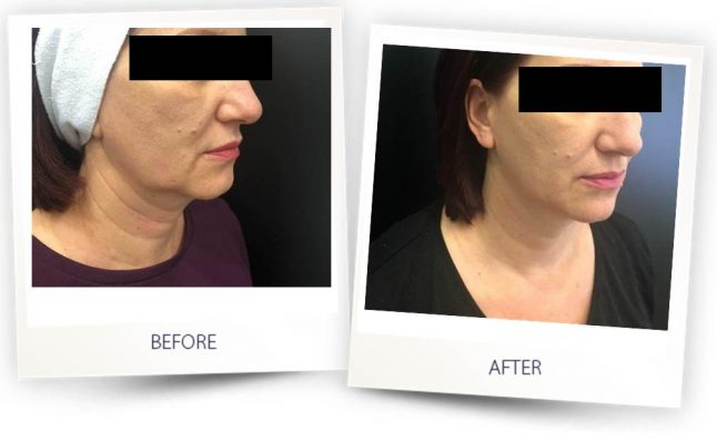 Woman with incredible before and after results from face contorting treatment with Alma laser at Wellife Ageless Center.