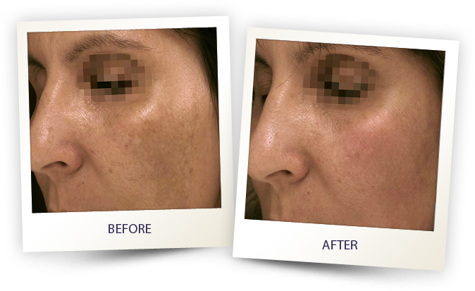 Eye area before and after Alma laser accent prime skin rejuvenation in Sandy Springs.
