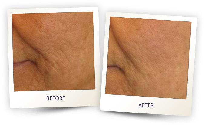 Cheek and mouth area before and after alma laser skin rejuvenation.