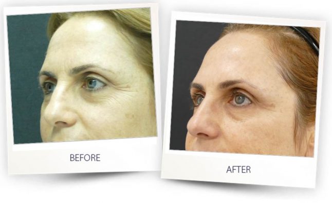 Upper face of middle aged woman showing before and after results of Facial rejuvenation with Alma laser accent prime treatment in Sandy Springs.