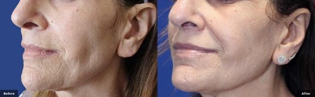 Before and after Secret RF Microneedling treatment in Sandy Springs.