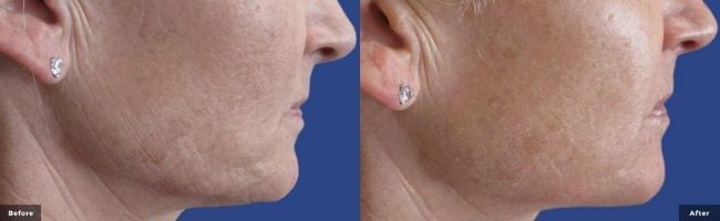 Cheek and jaw area before and after secret RF Microneedling treatment at Wellife Center.