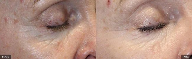 Eye are before and after Secret RF Microneedling treatment in Sandy Springs.