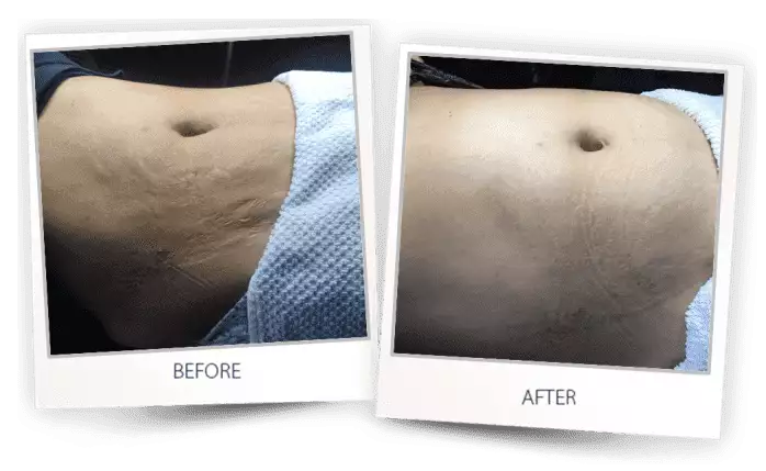 Womans abdomen showing before and after results of stretch mark reduction at Wellife Center using Accent Prime.