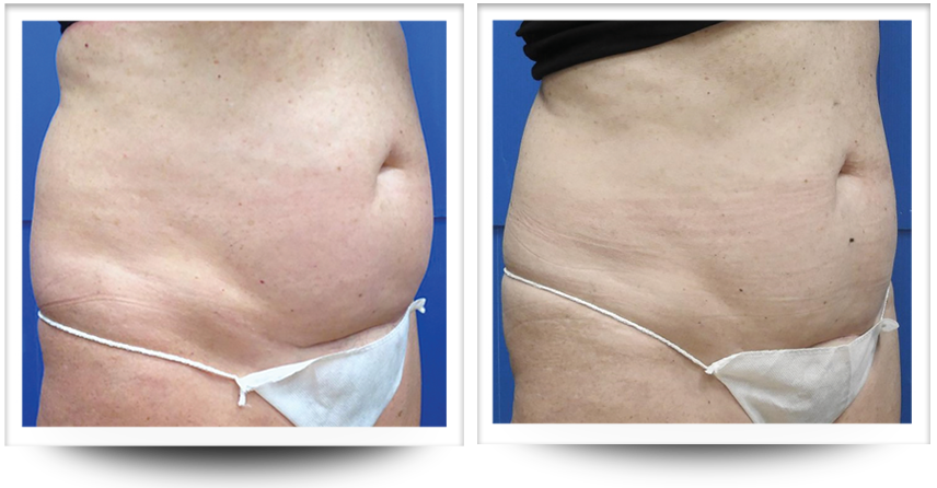 Abdomen before and after Body contouring with Accent prime.