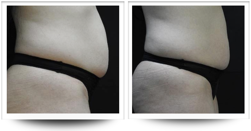 Belly before and after accent prime body contouring treatment at Wellife.