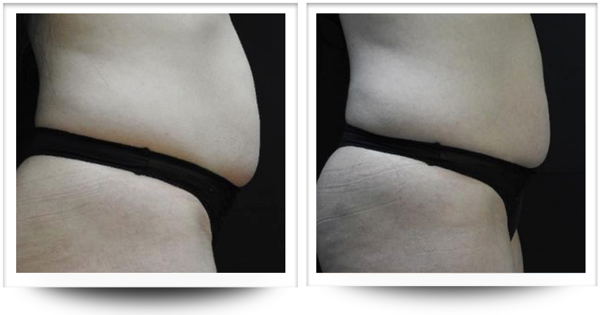 Belly before and after accent prime body contouring treatment at Wellife.