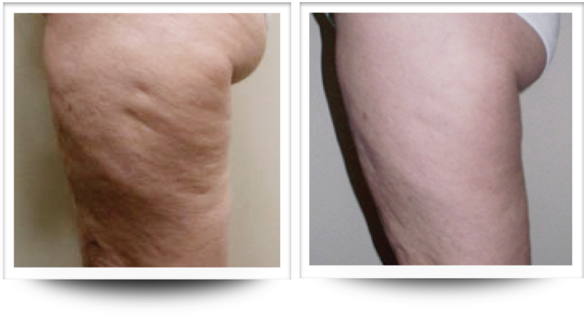 Thighs with incredible before and after results from cellulite treatment in Sandy Springs with Accent prime.