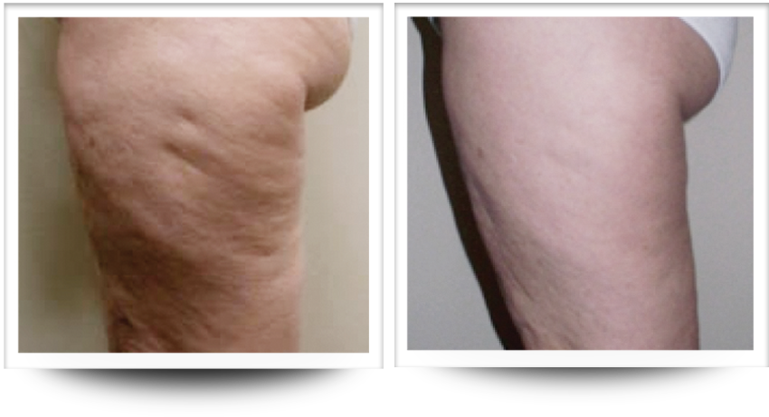 Thighs with incredible before and after results from cellulite treatment in Sandy Springs with Accent prime.