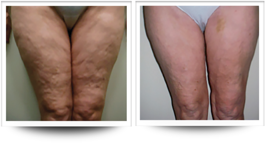Font view of things before and after cellulite treatment with accent prime at wellife ageless center.