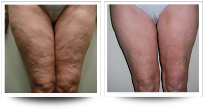 Font view of things before and after cellulite treatment with accent prime at wellife ageless center.