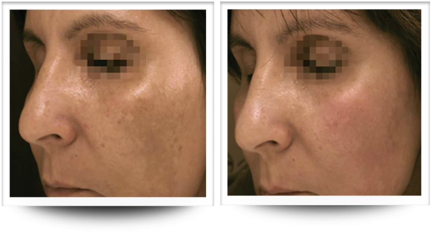Skin rejuvenation before and after accent prime treatment at Wellife.
