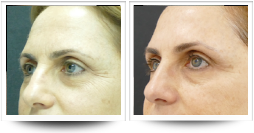 Eye are before and after skin rejuvenation with accent prime treatment in Sandy Springs.