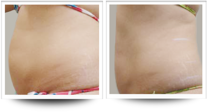 Skin tightening in the abdomen before and after treatment results with Accent Prime.