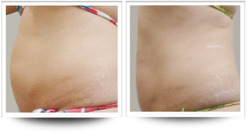 Skin tightening in the abdomen before and after treatment results with Accent Prime.