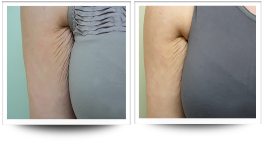 Under arm before and after skin tightening with accent prime treatment.
