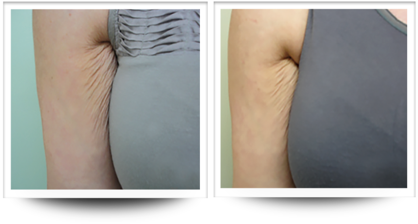 Under arm before and after skin tightening with accent prime treatment.