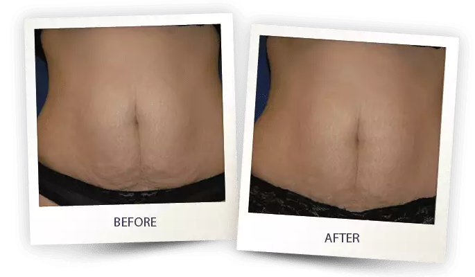 Accent prime for stretch mark reduction, abdomen showing before and after results.